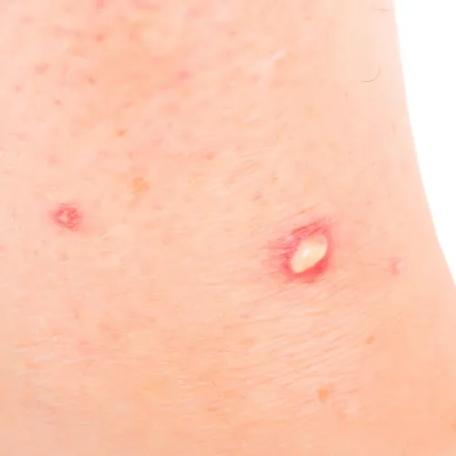 Photo d'une morsure / piqûre de fourmi rouge sur une peau humaine.